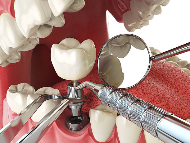Best Knocked-Out Tooth Emergency  in Smoke Rise, AL